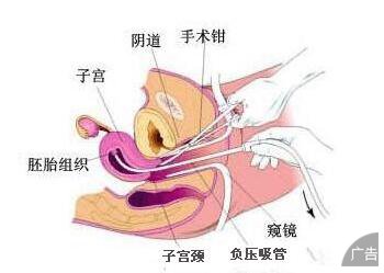 遇到哪几种情况需要进行引产手术