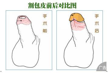 究竟是什么原因引起包皮过长的呢