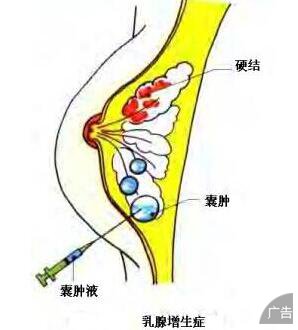 乳腺增生的症状都有哪些呢